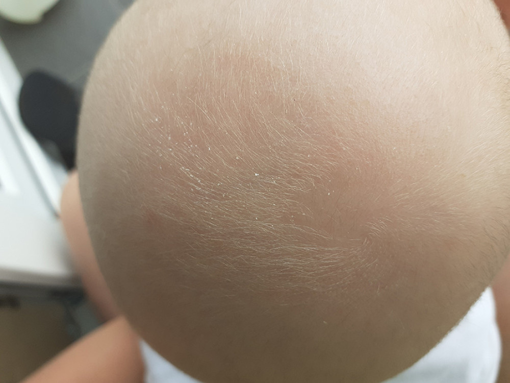 Salty child. Salt crystals visible on the baby’s hair.