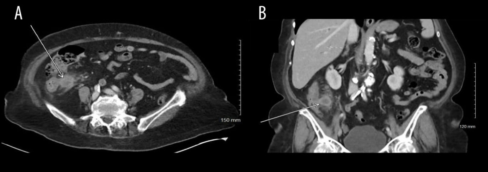 Original axial (A) and coronal (B) imaging highlighting associated inflammation, fluid collection and lymphadenopathy concerning for mass associated with cecum and ascending colon.