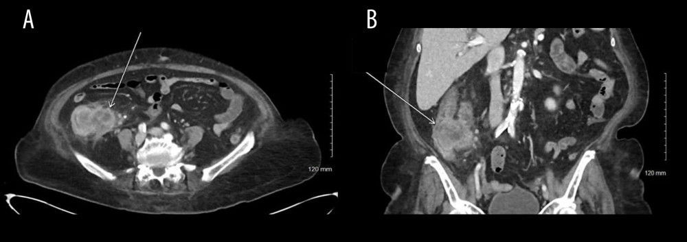 Expansion of previously identified collection concerning for mass associated with narrowing of ascending colon lumen in addition to wall thickening seen on axial (A) and coronal (B) computed tomography images.