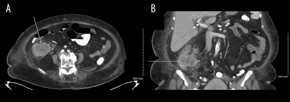 Further expansion of previously identified mass with near obliteration of ascending colon lumen seen on axial (A) and coronal (B) imaging.