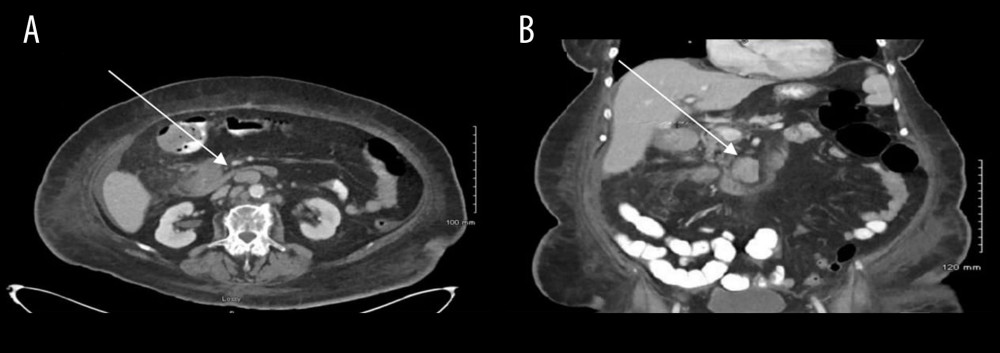 Associated lymphadenopathy after resection of previous right lower quadrant mass identified on axial (A) and coronal (B) imaging.