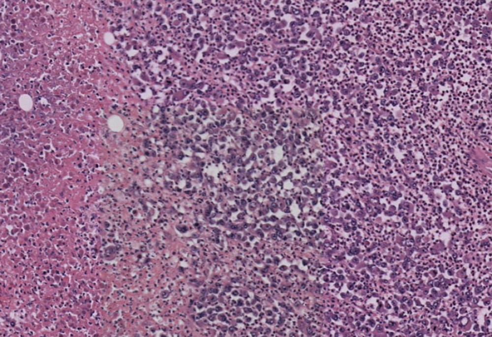 Pleomorphic nuclei, prominent nucleoli, and abundant mitotic figures adjacent to spindle cells and anaplastic fiber nuclei (hematoxylin and eosin).