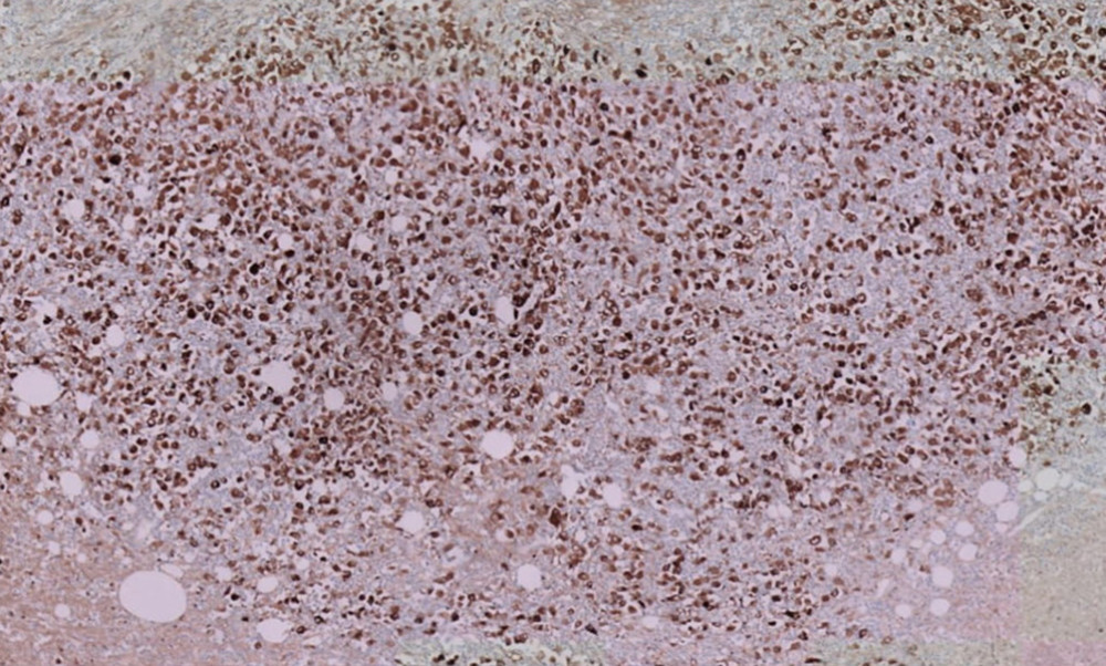 Calretinin-positive staining highlighting nuclei and cytoplasm of tumor cells.