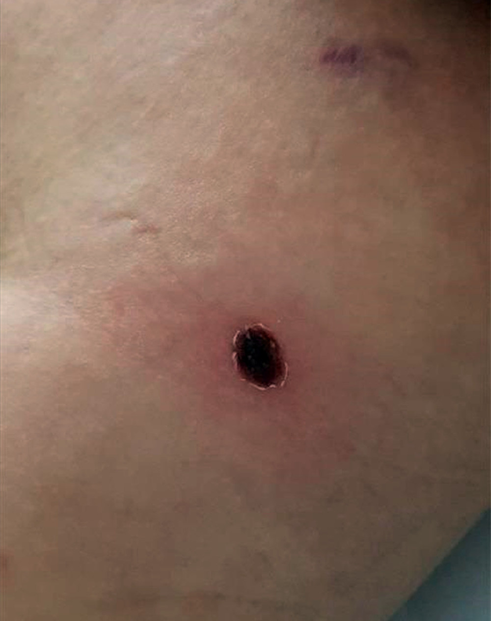 Eschar on the patient’s right thigh.