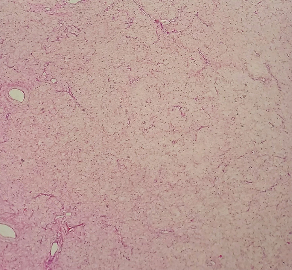 Microscopic appearance of vulvar myxoid liposarcoma. Tumor mass with prominent myxoid stroma, rich in “chicken wire” capillaries (Hematoxylin and Eosin, 100×).