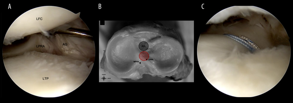 Arthroscopic photographs of a lateral posterior root tear (right knee). (A) Evidence of a significant root tear due to the non-anatomic, posterior position of the anterior cruciate ligament (ACL) tibial tunnel. (B) Cadaveric image demonstrating the position of the lateral and medial meniscus posterior root attachment (MPRA and LPRA) in relation to the anatomic ACL location (black circle) and current tunnel location (red circle). (C) Repair of the posterior horn of the lateral meniscus using a transtibial pull-out technique. LFC – lateral femoral condyle; LTP – lateral tibial plateau; AG – ACL graft.