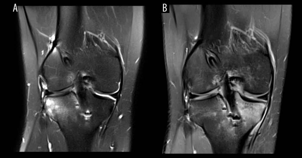 Postoperative follow-up (A) 6-month and (B) 12-month coronal magnetic resonance imaging views demonstrating an intact lateral meniscal repair without a sign of meniscal extrusion.