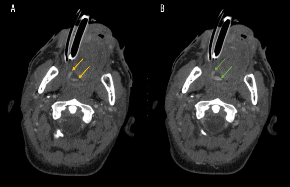 Oropharyngeal hemorrhage demonstrated on CTA head and neck. (A) Arterial phase, showing 2 foci of contrast blush involving the right lateral tongue (yellow arrows). (B) Portal venous phase, showing foci of contrast blush have expanded, suggesting active bleeding with venous pooling (green arrows).