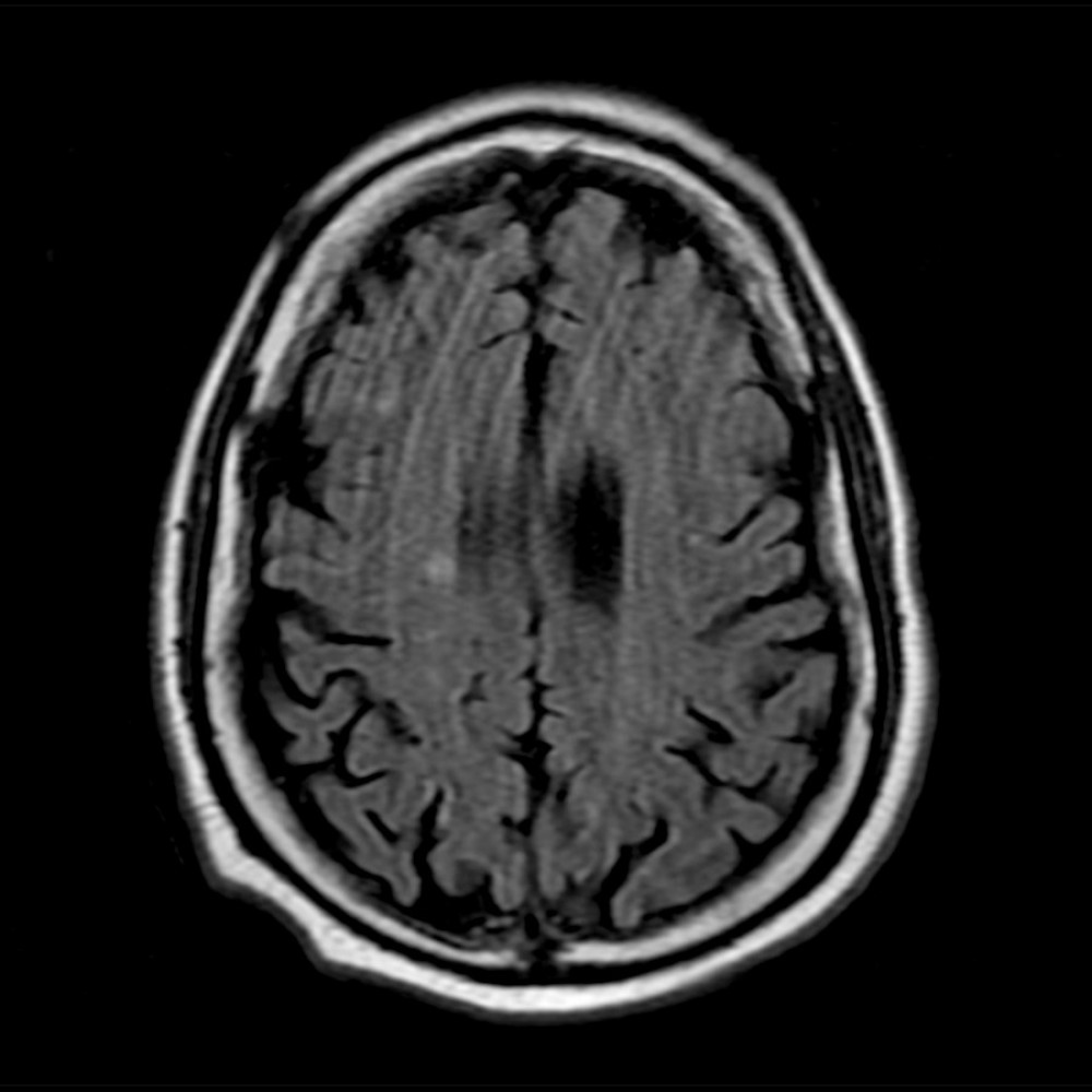 MRI of the brain with and without contrast axial T2 FLAIR view showing areas of multiple infarcts involving both cerebral hemispheres.