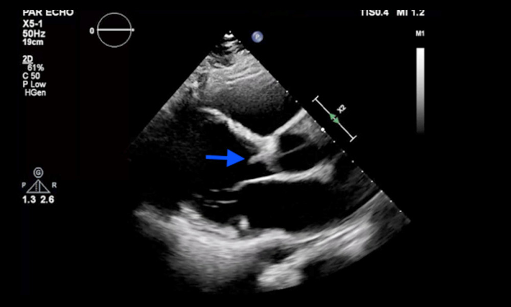 LVOT view of a transthoracic echocardiography showing an aortic vegetation on the noncoronary cusp.