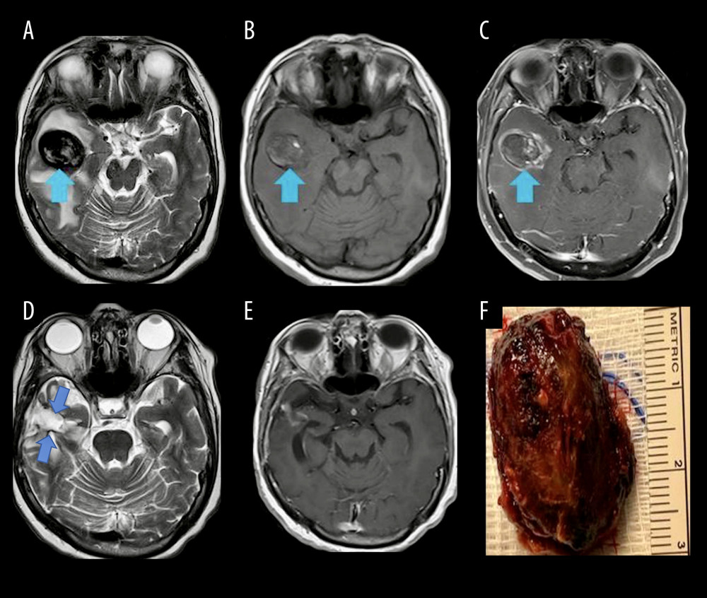 (A) Preoperative brain MRI, T2, showing mixed hyper- and hypointense mass (blue arrow) and surrounding brain edema. (B) Preoperative brain MRI, T1 without contrast, showing the hypointense mass (blue arrow). (C) Preoperative brain MRI, T1 after contrast injection, showing the heterogeneously enhancing mass (blue arrow). (D) Follow-up postoperative brain MRI 12 months after surgery, T2, showing the empty space of resected lesion (double blue arrow). (E) Follow-up postoperative brain MRI, 12 months after surgery, T1 after contrast injection, showing no residual mass. (F) Macroscopic photo of the lesion after gross total resection.