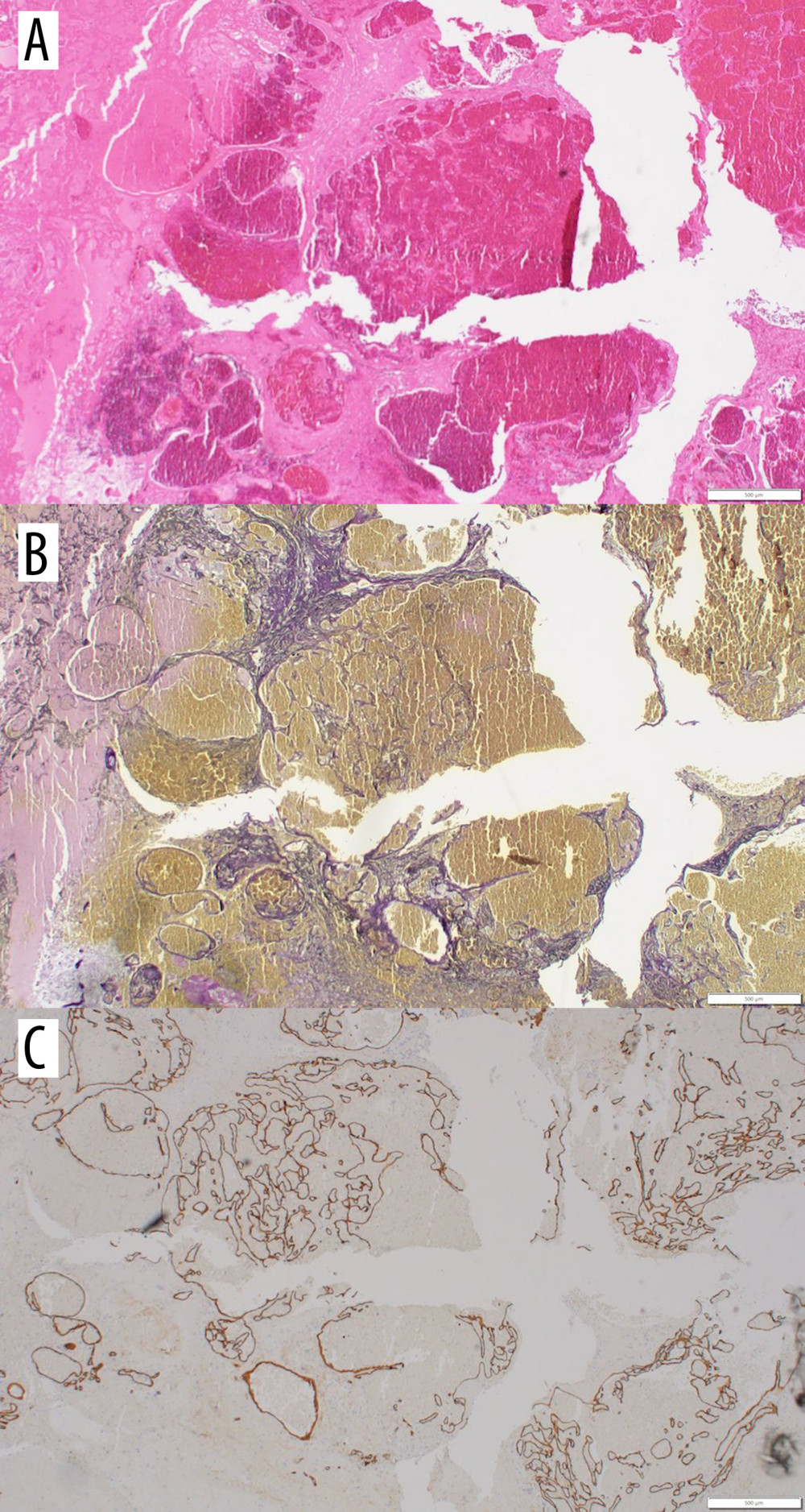 (A) Routine hematoxylin and eosin stain showed mainly hemorrhage and reactive glial tissue. (B) Elastic histochemical stain. Elastic stain highlighted network of vascular channels. (C) CD34 immunohistochemical stain (endothelial marker). CD34 showed thin vascular channels lined by endothelium.