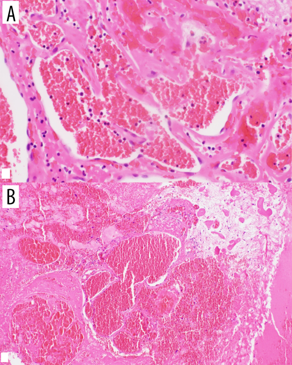 (A) 40-power magnification and (B) 20-power magnification of H&E staining of our case.