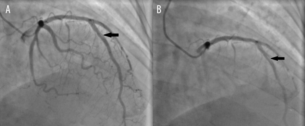 (A, B) Coronary angiography showing type A coronary dissection “arrow head” in the middle left anterior descending artery.