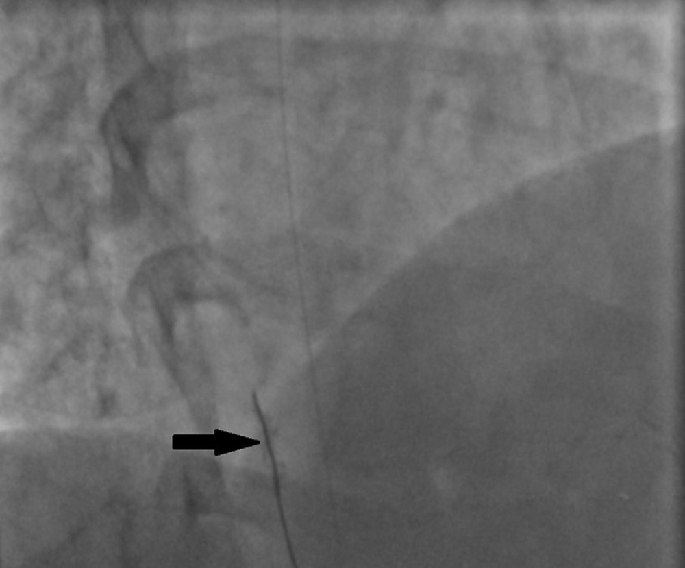 Cardiac catheterization showing the distorted stent “arrow head” attached to the guide wire before it was lost downstream in the descending aorta.