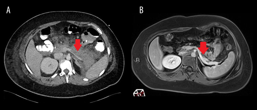 Case 1. (A) Computed tomography scan (CT scan) post-contrast axial image of abdomen showing splenic vein thrombosis and pancreatitis. Red arrow points to the splenic vein thrombosis and pancreatitis. (Filling defect in splenic vein with enlarged low-density pancreas and peripancreatic infiltration compatible with pancreatitis). (B) Magnetic resonance imaging (MRI) T1 post-contrast axial image of the abdomen showing resolved splenic vein thrombosis and normal pancreas. Red arrow points to resolved splenic vein thrombosis and pancreatitis. (Normal opacification of the splenic vein. The entirety of the splenic vein could not be displayed on this axial image given its curving and oblique trajectory but is normally opacified to the spleen on other images. Normal enhancement of pancreas and resolved peripancreatic inflammation).