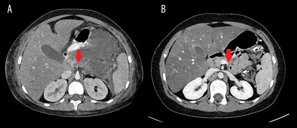 Case 2. (A) CT post-contrast axial image of the abdomen showing splenic vein thrombosis and pancreatitis. Red arrow points to splenic vein thrombosis and pancreatitis. (Filling defect in splenic vein with enlarged low-density pancreas and peripancreatic infiltration compatible with pancreatitis. The entirety of the splenic vein could not be displayed on this axial image given its curving and oblique trajectory, but there is no contrast present in the remainder of the splenic vein on other images). (B) CT post-contrast T1 axial image of the abdomen showing recanalized splenic vein and resolved pancreatic inflammation. Red arrow points to resolved splenic vein thrombosis and pancreatitis. (Normal opacification of the splenic vein to the splenic hilum. Resolved peripancreatic inflammatory changes. Decreased size of the pancreas.)