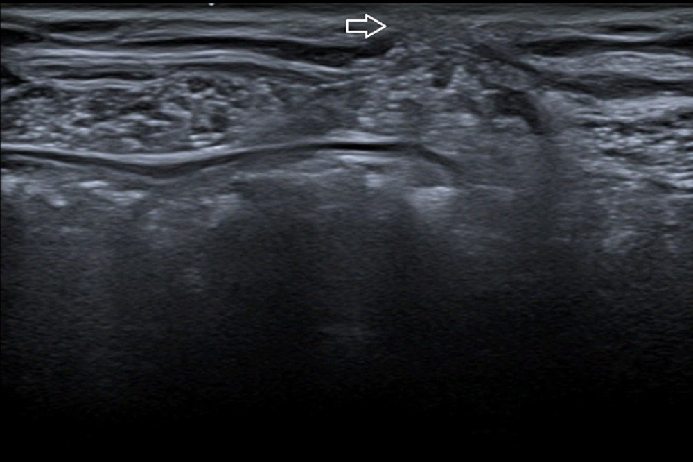 Ultrasound image showing the presence of one of the incisional hernias.