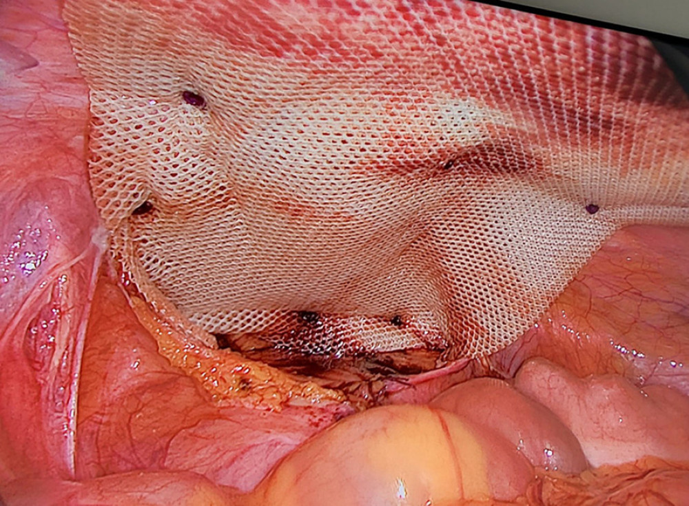 Intraoperative image showing mesh fixation on the pubic bone.