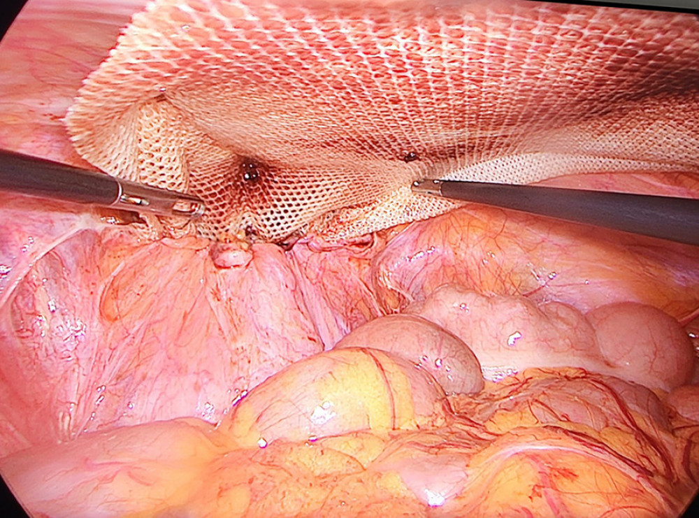 Intraoperative image that shows the urinary bladder fixation on the mesh in the previous anatomical position.