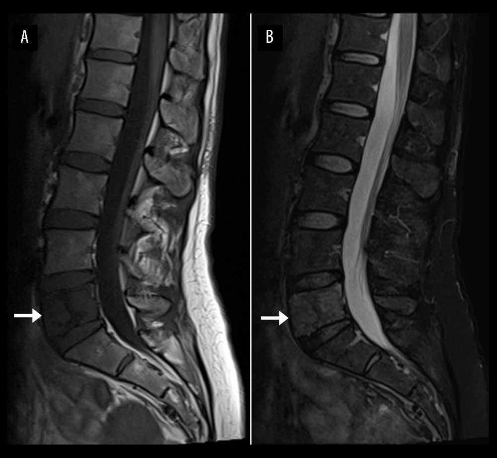 Lumbar spine magnetic resonance imaging. T1-weighted (A) and fat-suppressed T2-weighted (B) mid-sagittal views, showing marrow replacement of the entire L5 vertebral body, indicated by an abnormal heterogenous T1-weighted hypointense, T2-weighted hyperintense marrow signal change (arrows). The marrow change also extends into the right L5 pedicle (not shown).