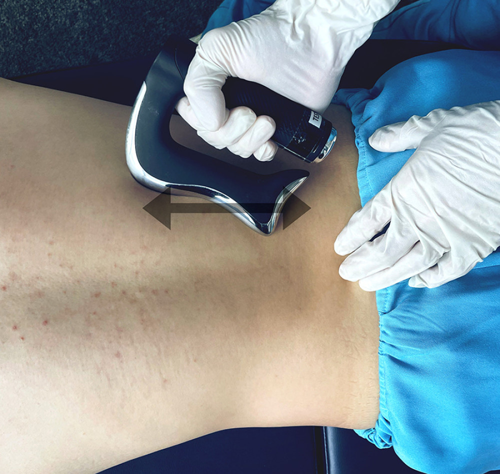 Administration of instrument-assisted soft tissue manipulation. The practitioner applies a thin layer of emollient/lotion to the patient’s skin then gently strokes the massage tool (Strig, Korea) across the skin surface (arrows).