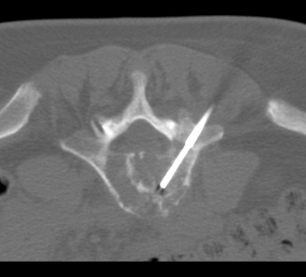Intra-procedural axial section of the computed tomography-guided biopsy of the L5 vertebra.