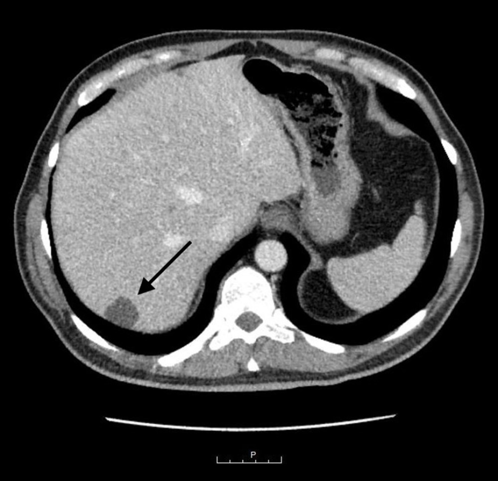 Magnetic resonance cholangiopancreatography shows multiple well-defined hepatic T2 hyperintensities, largest in the posterior right hepatic lobe, measuring 2.3 cm (arrow).