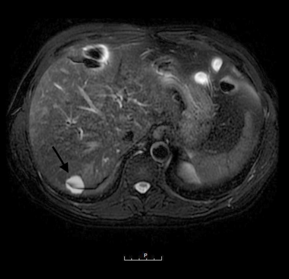 Abdominal computed tomography shows multiple scattered small liver lesions, with the largest in segment 7, measuring 2.8 cm in greatest diameter (arrow).