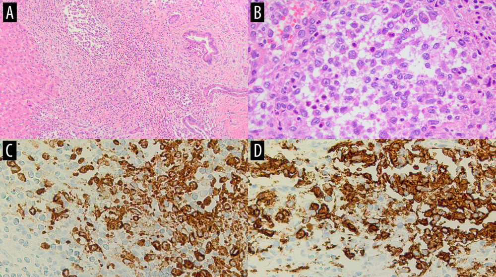 (A, 10× magnification; B, 40× magnification) Hematoxylin and eosin-stained slides show portal tract infiltration by a mediumsized cell population of mononuclear cells, characterized by the presence of cleared reniform nuclei, dispersed chromatin, scant, pale eosinophilic cytoplasm, and indistinct nucleoli. A mixed inflammatory cell infiltrate composed of lymphocytes, plasma cells, histiocytes, and numerous eosinophils are present. (C and D, 40× magnification) The lesional cells are positive for CD1a and Langerin immunohistochemical stains, respectively.