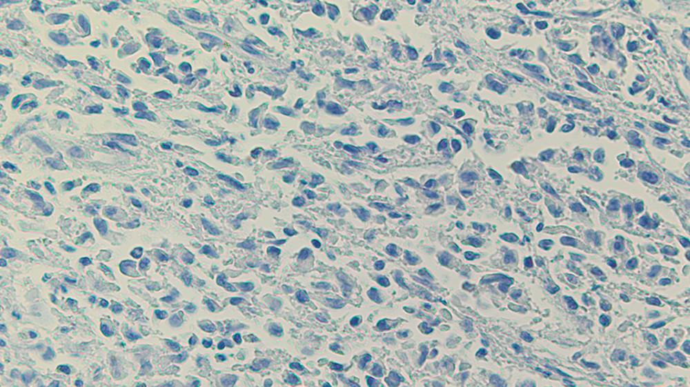 BRAF V600E immunohistochemical stain is negative in the lesional cells. 40× magnification.