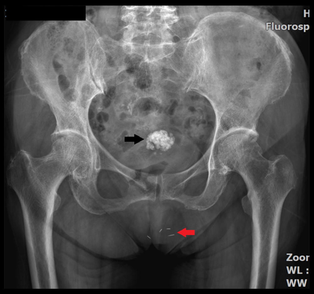Antero-posterior view of the pelvic radiograph taken in 2021 shows 4 linear hyper-density materials projected within the anterior pelvic soft tissue region (red arrow). There is also a popcorn calcification in the pelvis, characteristic of a calcified fibroid (black arrow).