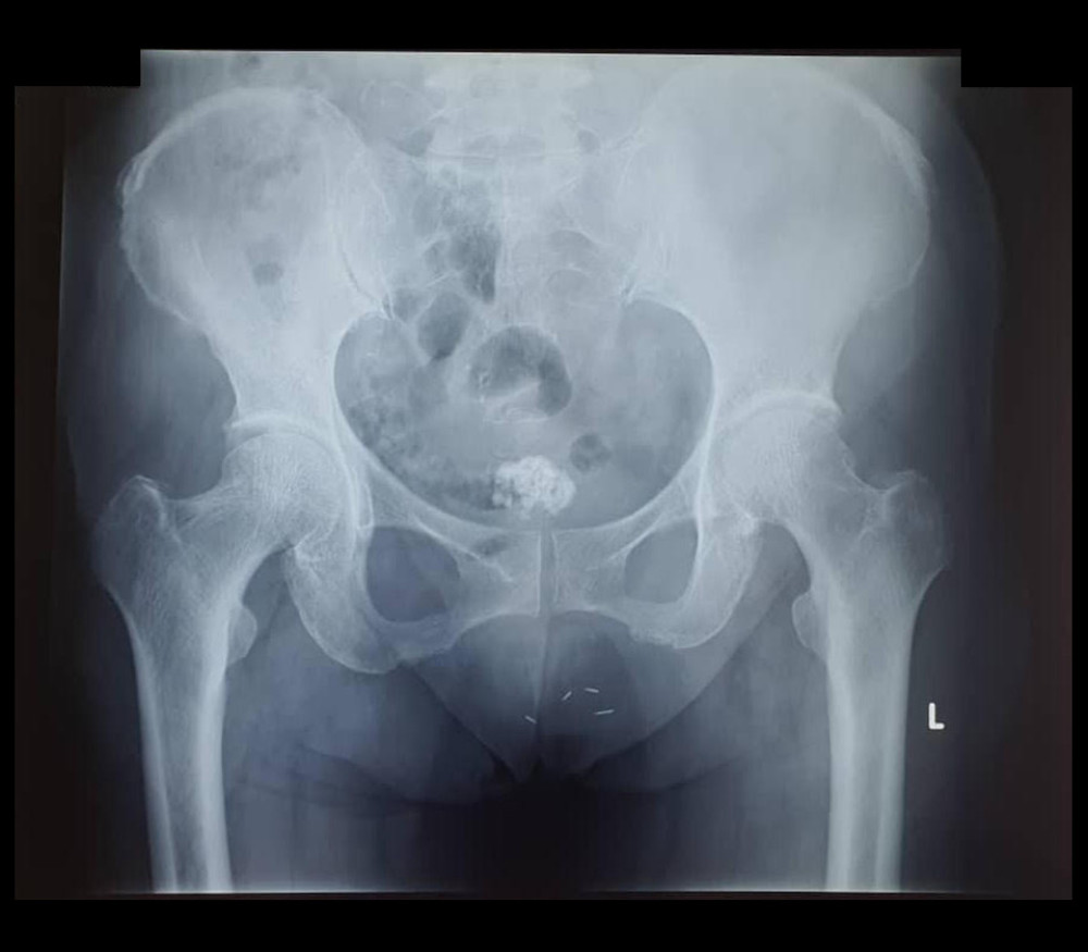 Antero-posterior view of a pelvic radiograph taken in 2017, shows similar findings as described in Figure 1.