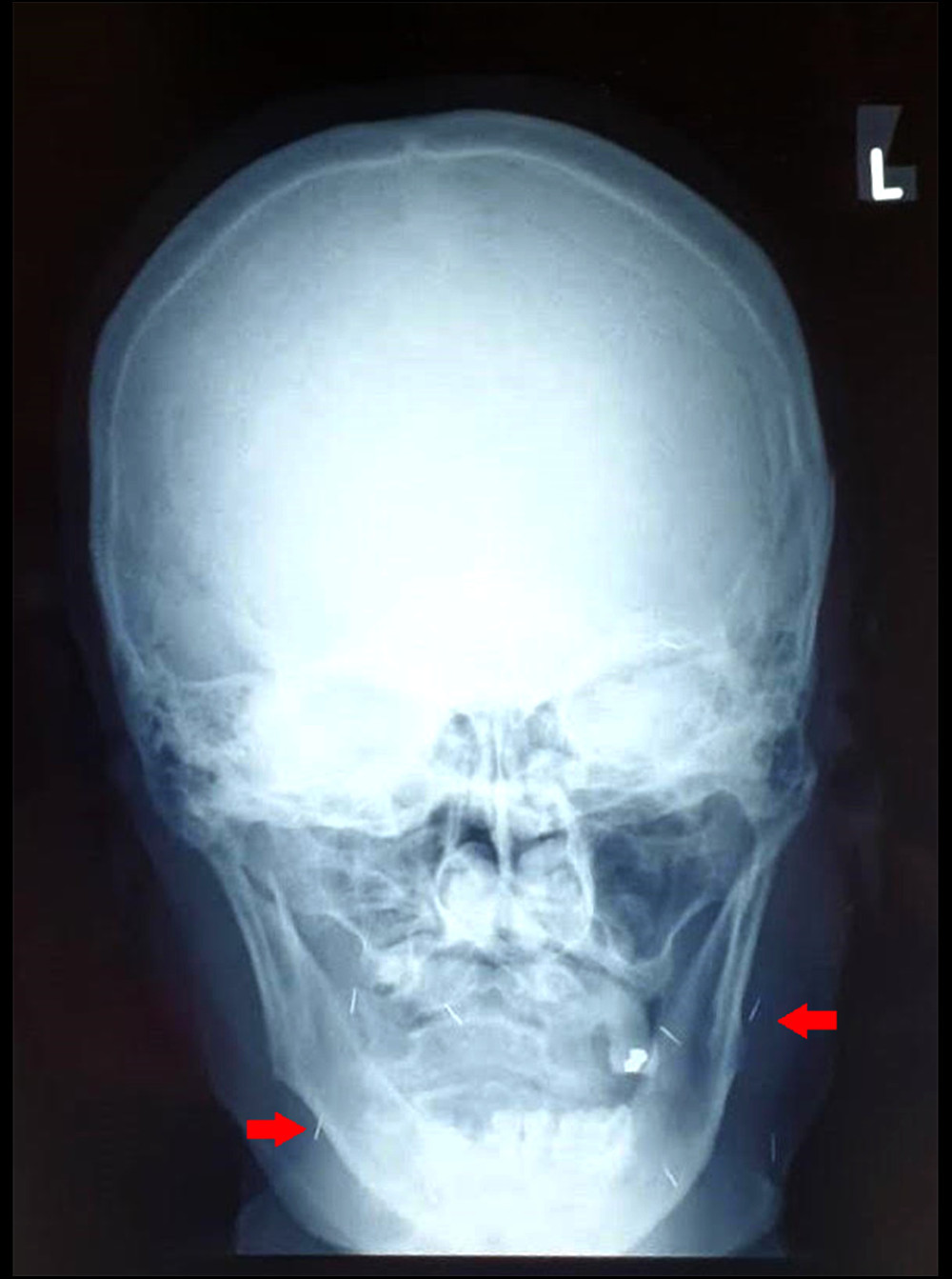 Antero-posterior view of a skull radiograph taken in 2017, shows 10 fine linear density needle-like foreign bodies over the maxillofacial area (red arrow).