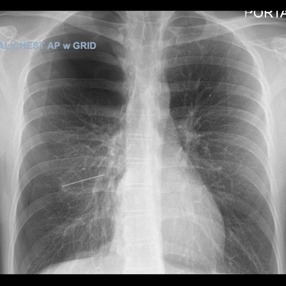 Chest X-ray showing foreign metallic object near the right pulmonary hilum and right-sided pneumothorax.