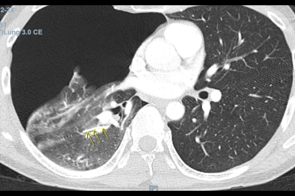 Axial view from CT angiogram showing foreign metallic object with the tip abutting a branch of the right pulmonary artery and large right pneumothorax.