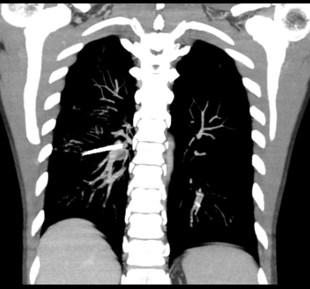 Coronal view from CT angiogram showing foreign metallic object abutting and surrounded by branches of the right pulmonary artery.