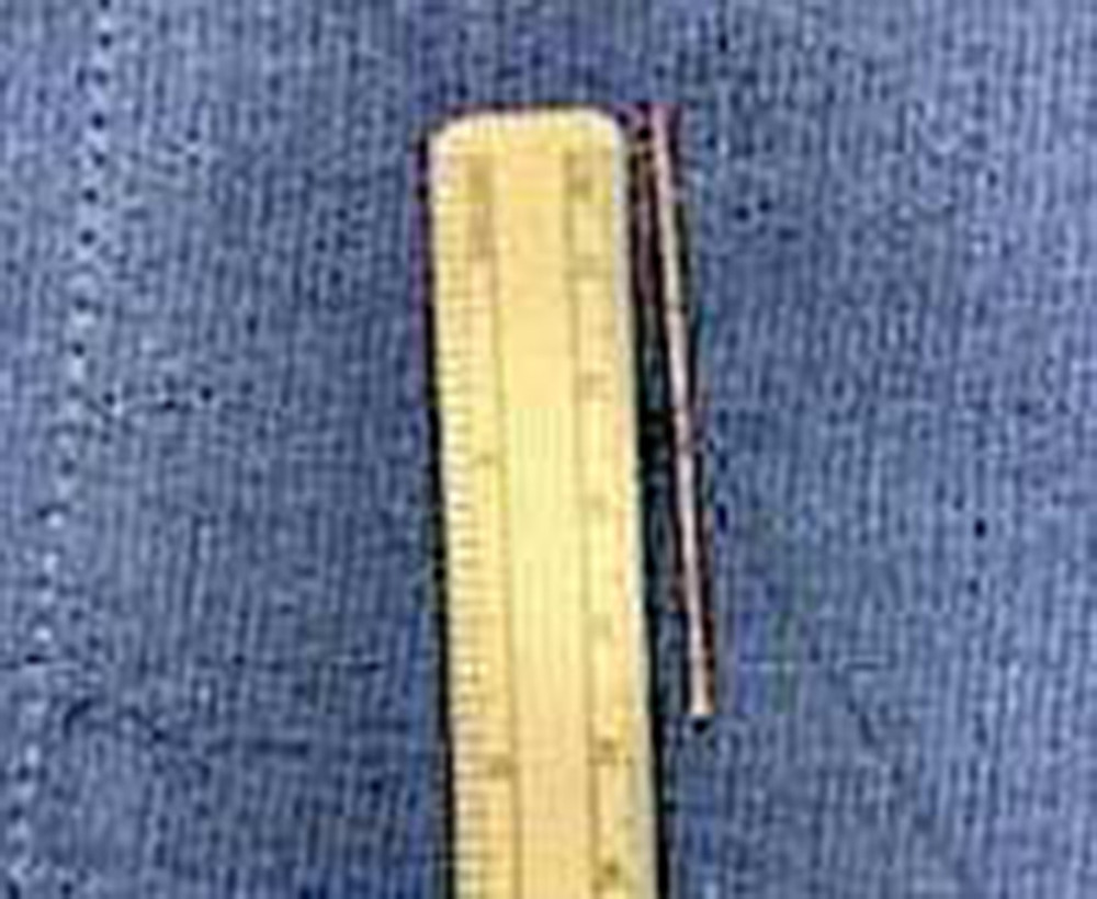 The 5-cm nail removed from patient’s thorax.