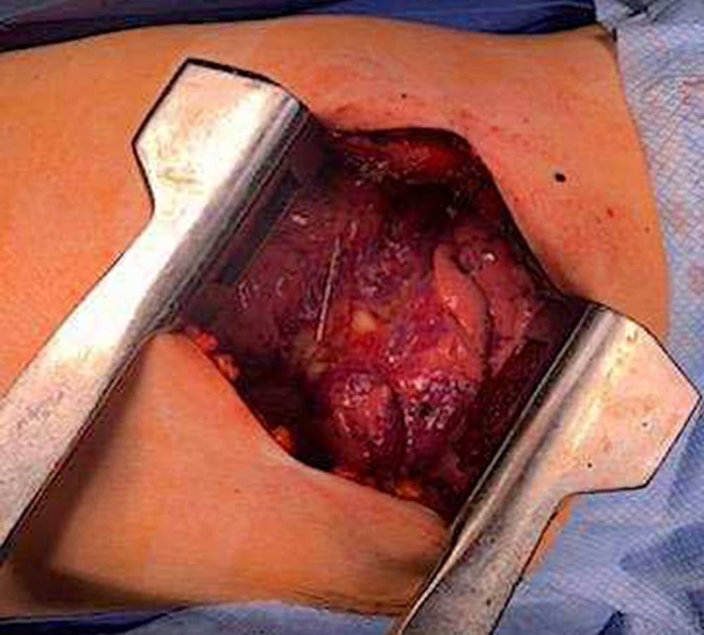 Intraoperative view of nail found in right hilum abutting the right middle lobe pulmonary artery branch and the bronchus intermedius during thoracotomy. Right side of picture corresponds to the patient’s cephalad and the bottom of the picture shows the anterior chest.