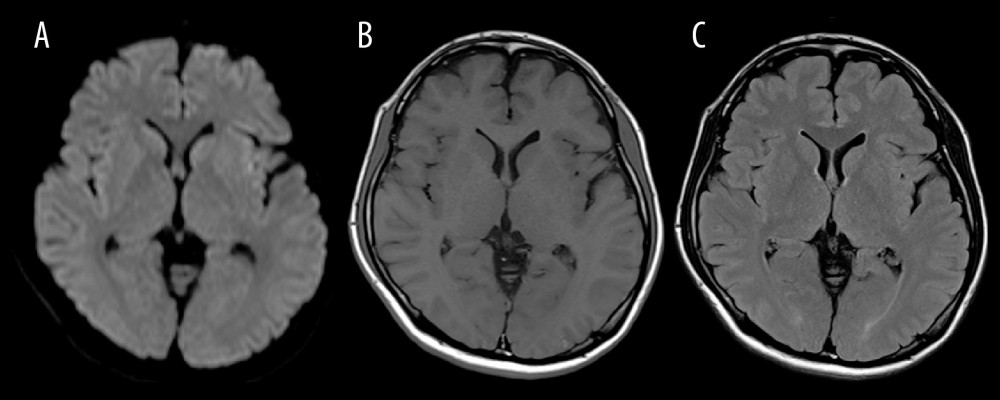 Cranial magnetic resonance imaging findings on admission. (A) Diffusion-weighted image, (B) T1-weighted image, (C) fluid-attenuated inversion recovery image. Cranial magnetic resonance images show no abnormalities, including high signal intensity in the basal ganglia on T1-weighted images, which can occur in patients with hepatic encephalopathy.