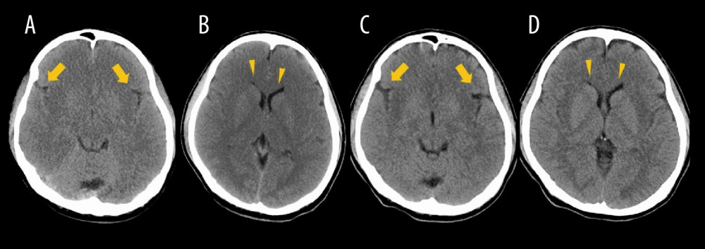 Cranial computed tomography findings on hospital days 3 and 5. (A, B) on hospital day 3, (C, D) on hospital day 5. Cranial computed tomography on hospital day 3 shows whole-brain edema with an indistinct cortico-medullary junction at the base of the brain. There is narrowing of the Sylvian fissure (A, arrows) and lateral ventricles (B, arrowheads) with no abnormal findings in the basal ganglia. Cranial computed tomography on hospital day 5 shows the marked improvements in whole-brain edema, the indistinctness of the cortico-medullary junction, and the narrowing of the Sylvian fissure (C, arrows). The narrowing of the lateral ventricles has persisted (D, arrowheads).