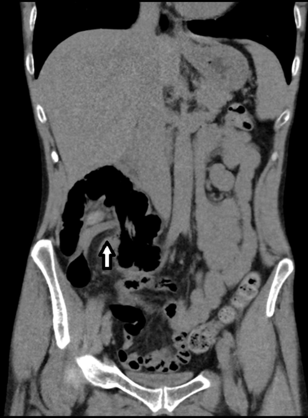 Axial image of abdominal CT scan in soft tissue window demonstrating an intussuscept-like swirl of bowel loops (white arrow) in the right lower abdomen involving part of the distal ileum, cecum, and ascending colon.