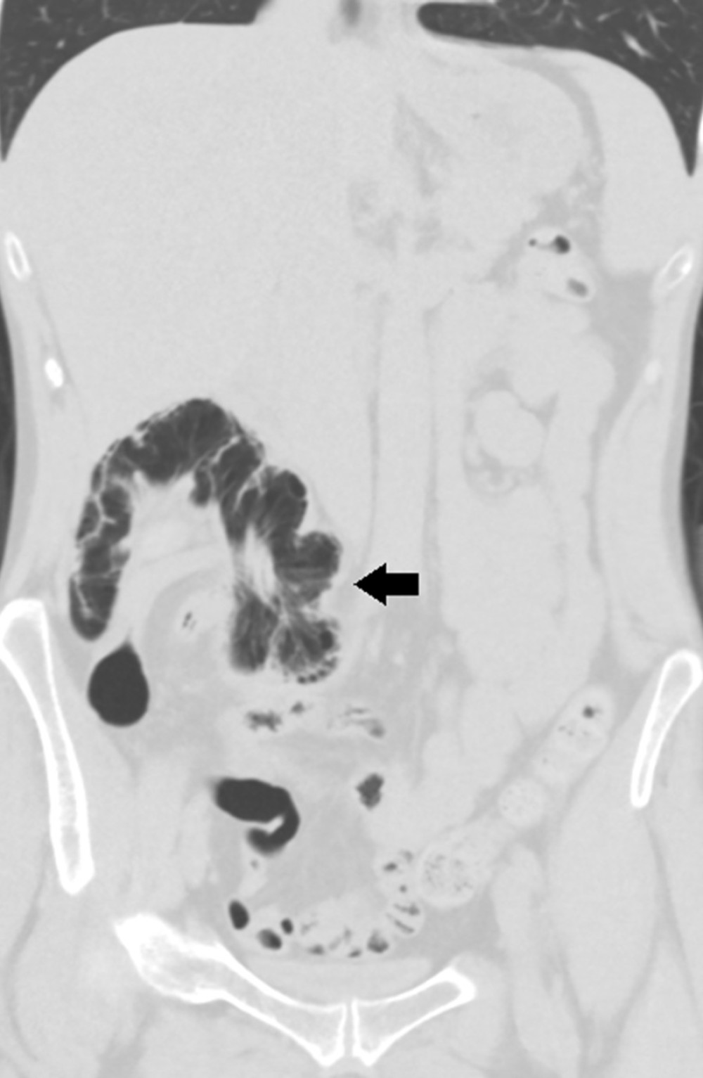Axial image of abdominal CT scan in lung window demonstrating air in the bowel wall loculated around an intussuscept-like swirl of bowel loops (black arrow).