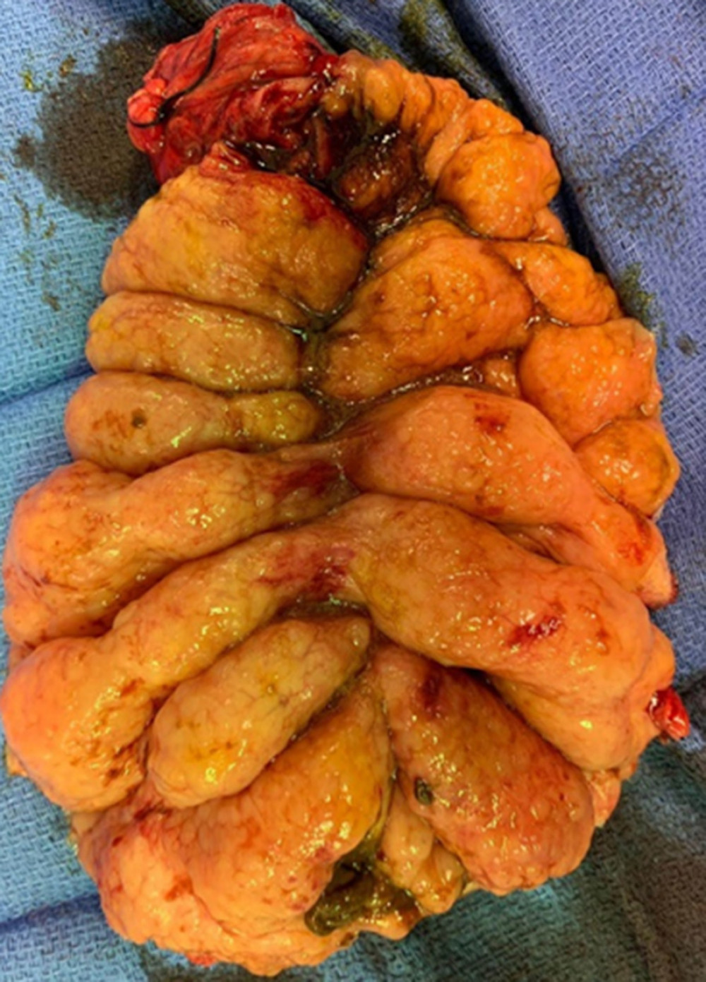 Pathology specimen – right colon opened showing multiple submucosal cysts.