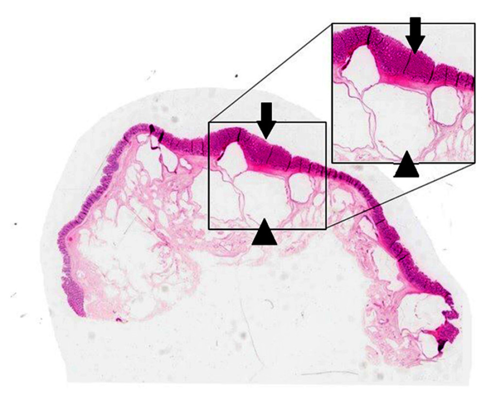 Histological picture of the colonic wall showing empty cysts (arrowheads) in the submucosa and unremarkable mucosa (arrows). Magnification ×50 (larger picture) and ×200 (smaller picture); H&E stain.