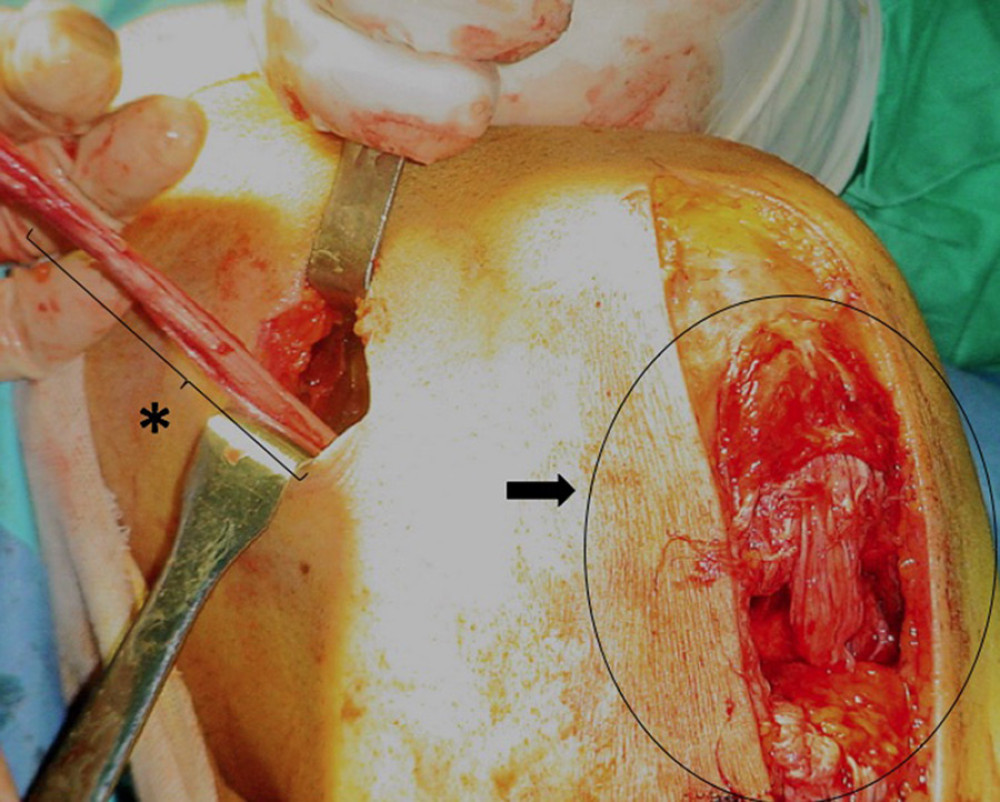 T2 graft using tendons from the semitendinosus and gracilis muscles for the reconstruction of the anterior cruciate ligament (asterisk) and total break of the patellar tendon (arrow).