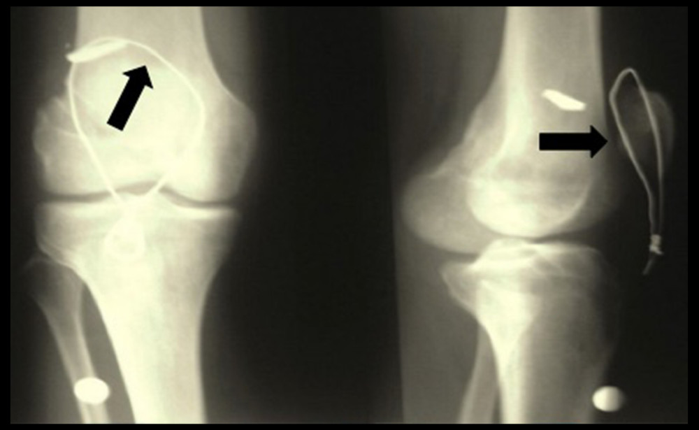 Cerclage wire used to protect the patellar tendon repair (arrow).