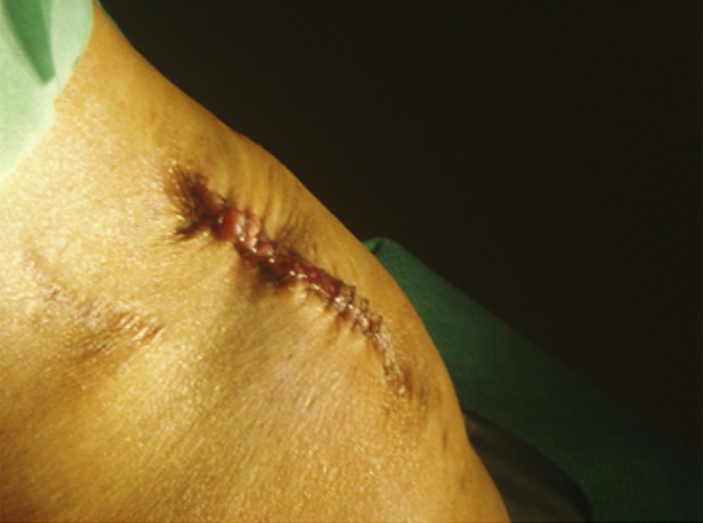 The scar caused after reconstruction of the knee before mobilizing to elasticize it and improve functionality.