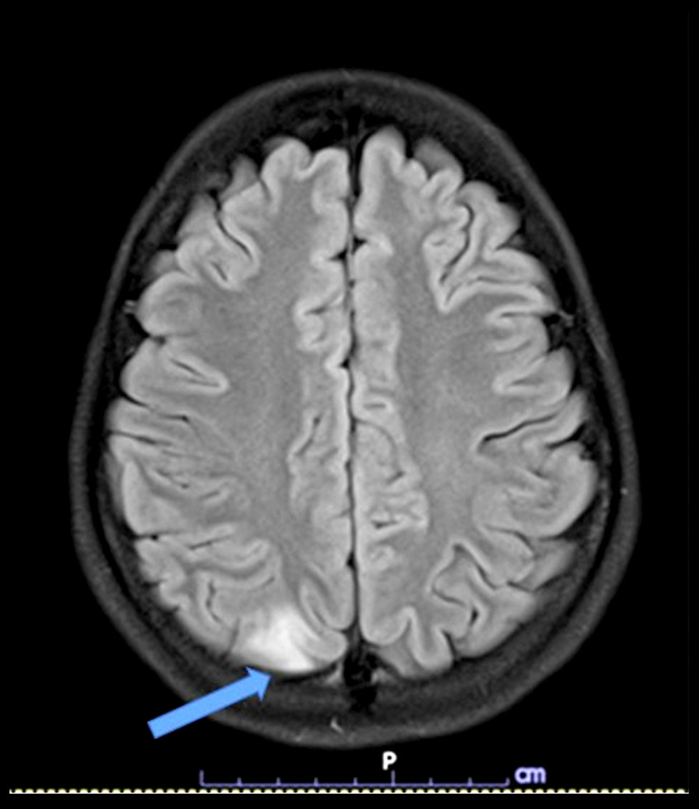 Magnetic resonance imaging of brain of T2/fluid-attenuated inversion recovery revealed hyperintensity at cortical and subcortical areas of parieto-occipital lobes and cortical area of the left parietal lobe (arrow).