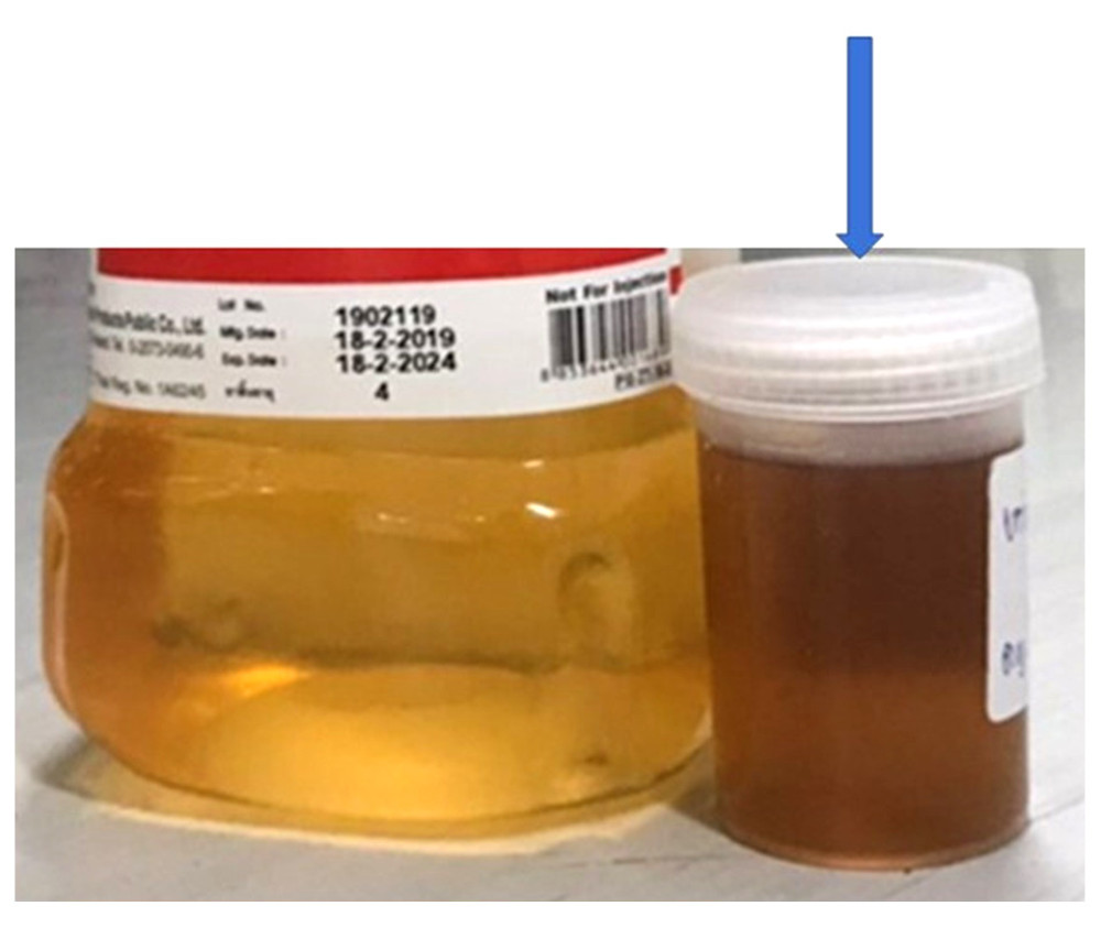 Fresh urine and urine after sunlight exposure, showing the brown color (arrow).